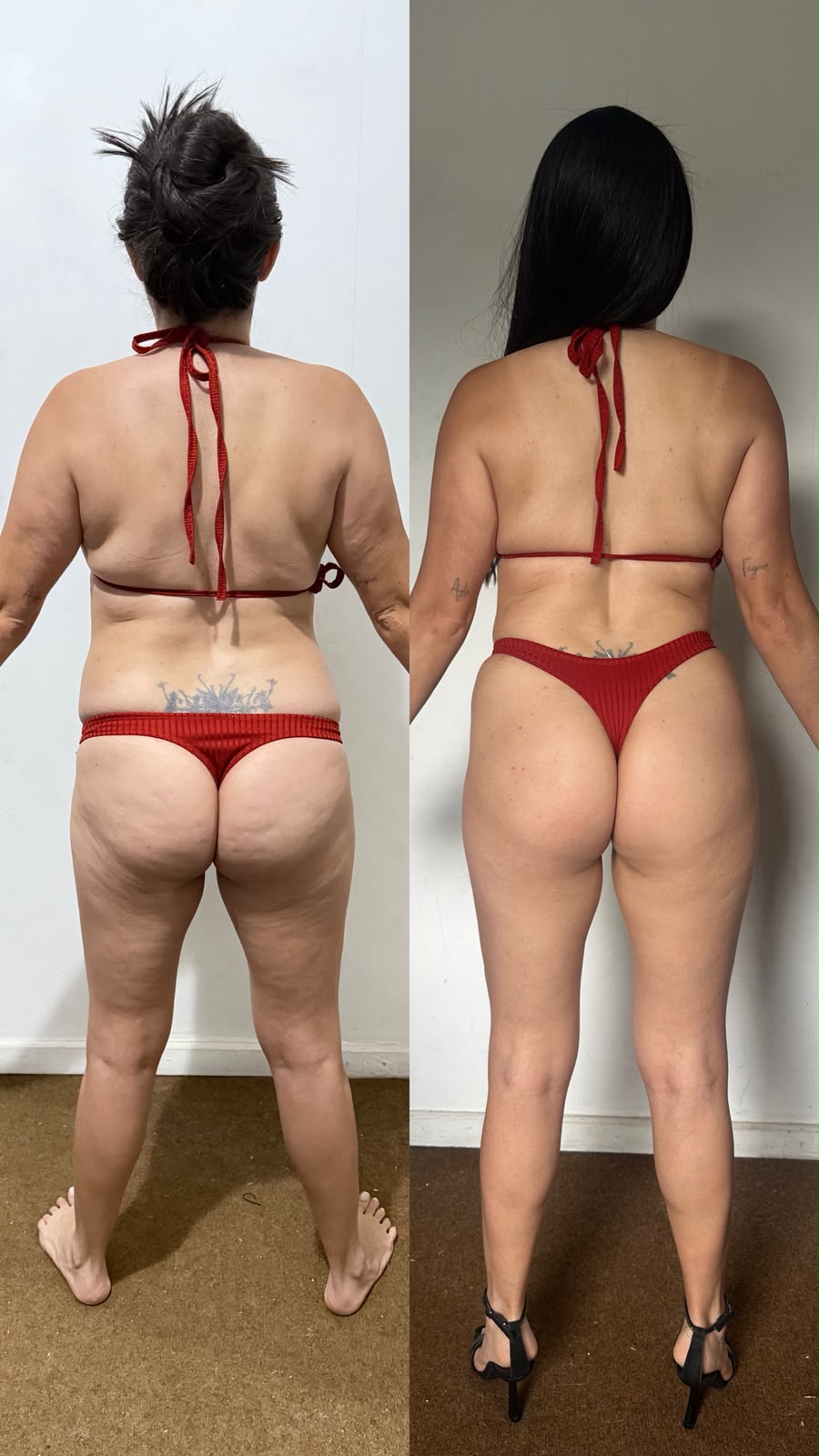 Antes e depois do Body Harmony — vista posterior